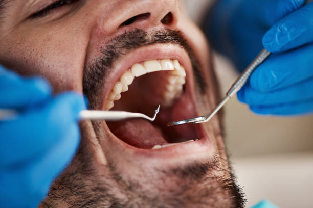 Best Emergency Gum Treatment in Egypt Lake Leto, FL